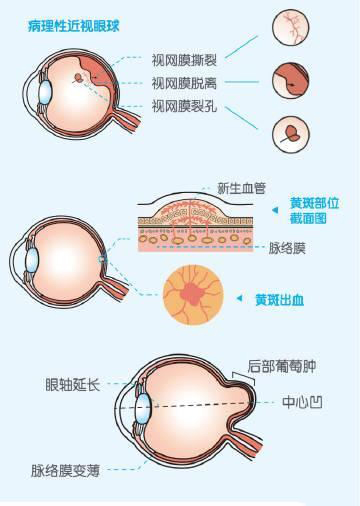 病理性近視.jpg