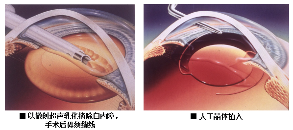 眼藥水,是,白內障,患者,的,“,救星,”,眼藥水, 眼藥水,是,白內障,患者,的,“,救星,”,眼藥水,