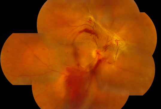 預防致盲性糖網眼病，糖尿病患者應注意這些關鍵點