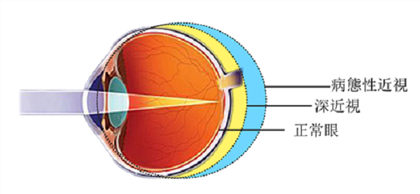 2歲半寶寶近視高達900度！深度近視者需小心視網膜脫落找上門來！