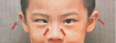 家長(zhǎng)們注意了？斜視對(duì)孩子的影響，比你想象的更嚴(yán)重！