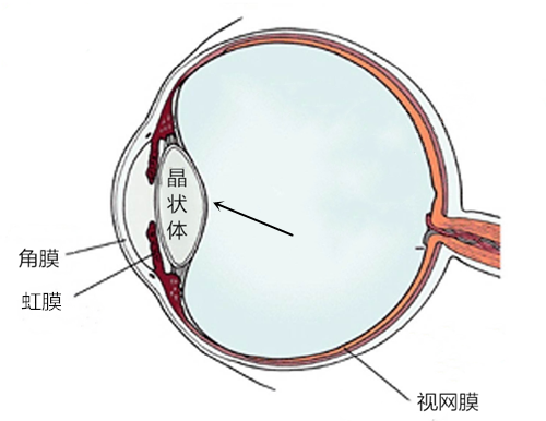 預防,致盲,性糖,網,眼病,糖尿,病患者,應注意, 預防,致盲,性糖,網,眼病,糖尿,病患者,應注意,