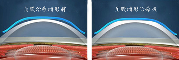 近視低齡化日漸突出，看OK鏡如何來使近視進程“急剎車”。