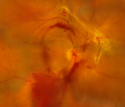 學(xué)巴菲特每天5罐可樂？小心這些致盲性眼病找上你