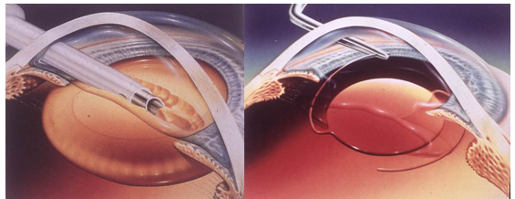 學(xué)巴菲特每天5罐可樂？小心這些致盲性眼病找上你