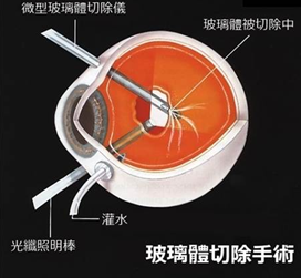 劇烈,運(yùn)動(dòng),還會(huì),導(dǎo)致,視網(wǎng)膜,脫落,高度,近視, 劇烈,運(yùn)動(dòng),還會(huì),導(dǎo)致,視網(wǎng)膜,脫落,高度,近視,