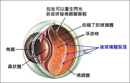 你知道什么是飛蚊癥嗎