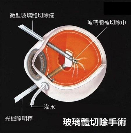 這層膜很重要，視網膜脫落之后極危險