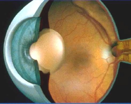 白內障治療方法