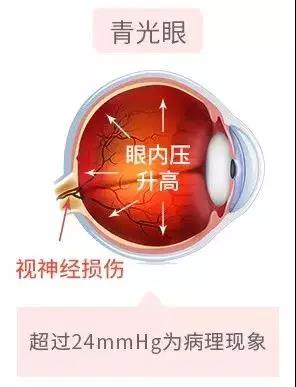 濫用眼藥水，當心青光眼找上門！