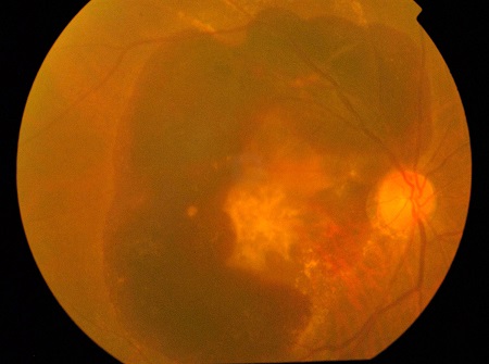 黃斑是什么,黃斑變性,黃斑病變,黃斑變性高發群 黃斑是什么,黃斑變性,黃斑病變,黃斑變性高發群