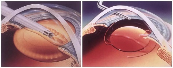 現代,白內障,手術,可,同時,改善,多種,眼疾, 現代,白內障,手術,可,同時,改善,多種,眼疾,