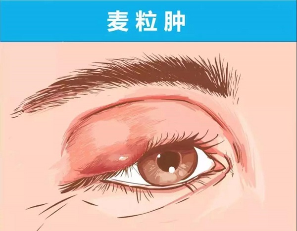 眼睛腫了，到底應該熱敷還是冷敷？這次終于解釋清楚了！