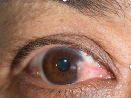 眼睛里長了小翅膀,翼狀胬肉怎么辦,翼狀胬肉治療 眼睛里長了小翅膀,翼狀胬肉怎么辦,翼狀胬肉治療