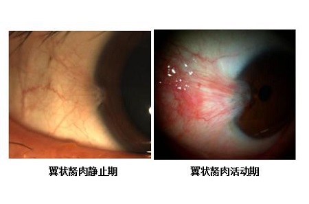 眼睛里長了小翅膀,翼狀胬肉怎么辦,翼狀胬肉治療 眼睛里長了小翅膀,翼狀胬肉怎么辦,翼狀胬肉治療