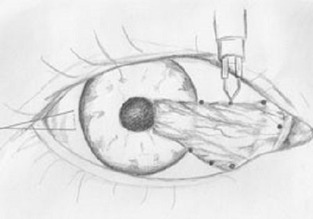 眼睛里長了小翅膀,翼狀胬肉怎么辦,翼狀胬肉治療 眼睛里長了小翅膀,翼狀胬肉怎么辦,翼狀胬肉治療