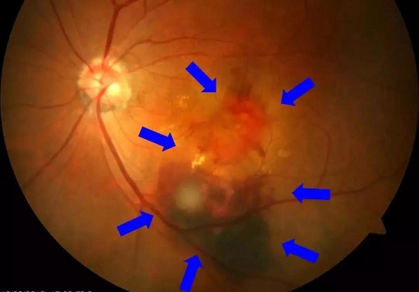 眼睛,出現,這,幾種,癥狀,黃斑,變性,很可能, 眼睛,出現,這,幾種,癥狀,黃斑,變性,很可能,