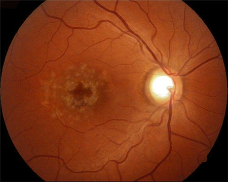 黃斑營養不良是什么,黃斑營養不良病因,黃斑營養 黃斑營養不良是什么,黃斑營養不良病因,黃斑營養