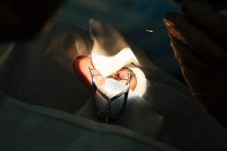 糖尿病白內障,白內障手術,白內障治療 糖尿病白內障,白內障手術,白內障治療