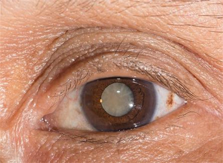 白內障和青光眼