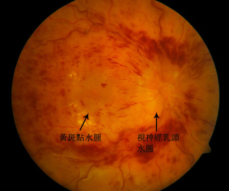 眼中風(fēng)與高血壓