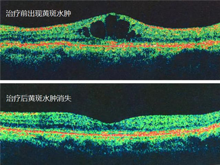 眼中風(fēng)治療