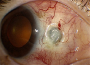 眼睛發紅,鞏膜炎癥狀,鞏膜炎和紅眼病的區別,鞏 眼睛發紅,鞏膜炎癥狀,鞏膜炎和紅眼病的區別,鞏