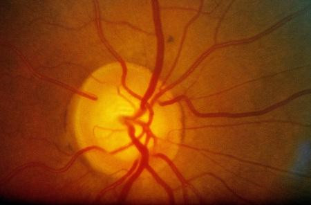 摸黑玩手機,急性青光眼,青光眼治療,青光眼手術(shù) 摸黑玩手機,急性青光眼,青光眼治療,青光眼手術(shù)