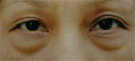 眼袋危害,眼袋形成原因,眼袋怎么去除,割除眼袋 眼袋危害,眼袋形成原因,眼袋怎么去除,割除眼袋