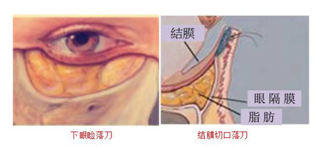 眼袋危害,眼袋形成原因,眼袋怎么去除,割除眼袋 眼袋危害,眼袋形成原因,眼袋怎么去除,割除眼袋