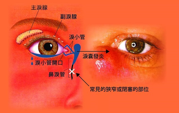 別讓冷空氣變成淚道病的“導(dǎo)火線”！
