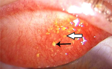 眼結(jié)石圖片
