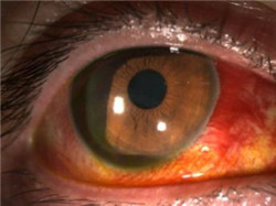 結膜出血,眼睛血紅,結膜下出血,結膜出血原因,結 結膜出血,眼睛血紅,結膜下出血,結膜出血原因,結