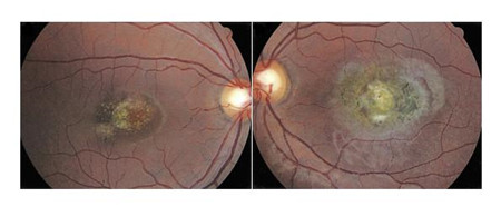 知覺缺陷型眼震