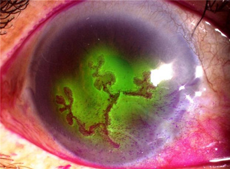 角膜潰瘍是什么,角膜潰瘍能治好嗎,角膜潰瘍治療 角膜潰瘍是什么,角膜潰瘍能治好嗎,角膜潰瘍治療