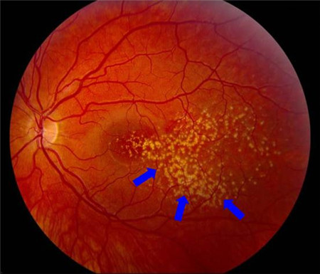 吸煙危害,黃斑退化原因,黃斑退化類型,黃斑病變 吸煙危害,黃斑退化原因,黃斑退化類型,黃斑病變