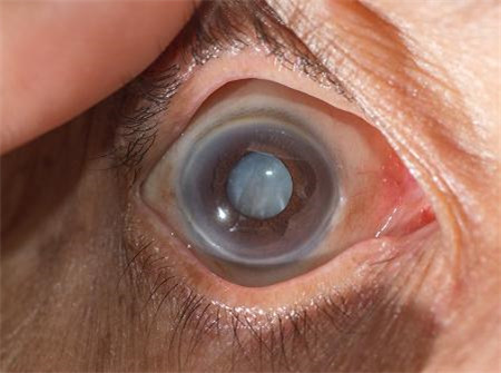 白內障要熟了才能做嗎,白內障手術什么時候做 白內障要熟了才能做嗎,白內障手術什么時候做