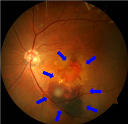 黃斑變性,黃斑退化,黃斑變性因素,黃斑變性癥狀 黃斑變性,黃斑退化,黃斑變性因素,黃斑變性癥狀
