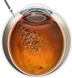 黃斑變性,黃斑退化,黃斑變性因素,黃斑變性癥狀 黃斑變性,黃斑退化,黃斑變性因素,黃斑變性癥狀