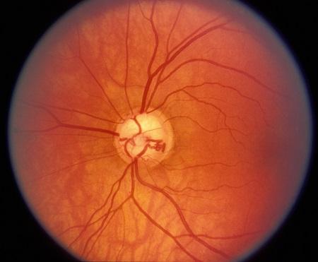 青光眼需要注意什么