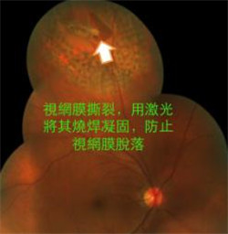 激光治療視網(wǎng)膜脫落