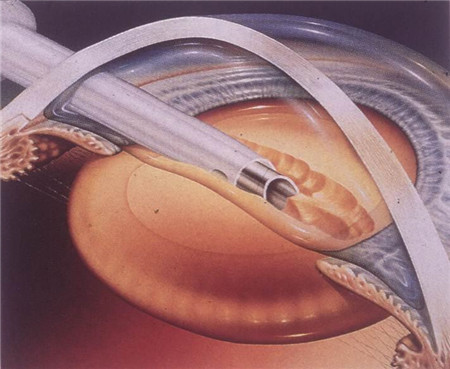 超聲乳化白內障摘除手術