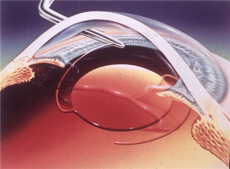 白內障人工晶體植入