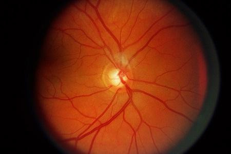 青光眼謠言,青光眼誤區,青光眼年齡,青光眼治療 青光眼謠言,青光眼誤區,青光眼年齡,青光眼治療