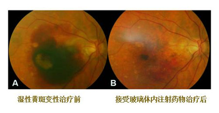 黃斑變性,致盲眼病,黃斑退化,黃斑變性治療 黃斑變性,致盲眼病,黃斑退化,黃斑變性治療