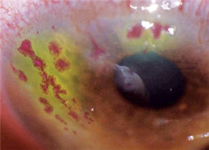 帶狀皰疹,生蛇上眼,眼部帶狀皰疹,帶狀皰疹治療 帶狀皰疹,生蛇上眼,眼部帶狀皰疹,帶狀皰疹治療