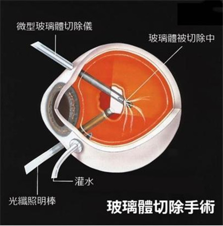 玻璃體切除手術治療視網膜脫落