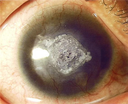 單純皰疹病毒眼病,皰疹角膜炎癥狀,皰疹角膜炎治 單純皰疹病毒眼病,皰疹角膜炎癥狀,皰疹角膜炎治