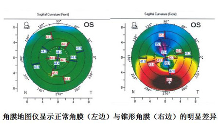 圓錐角膜的危險(xiǎn)性