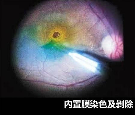 黃斑前膜手術治療